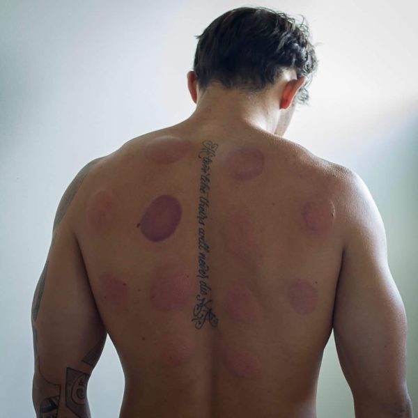 Cupping therapy Brisbane Cupping therapy, Brisbane clinic