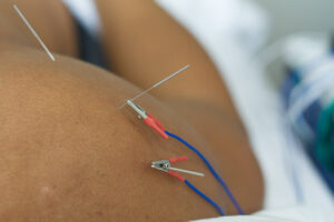 Electroacupuncture for shoulder pain