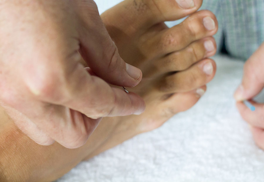 acupuncture-for-knee-cartilage