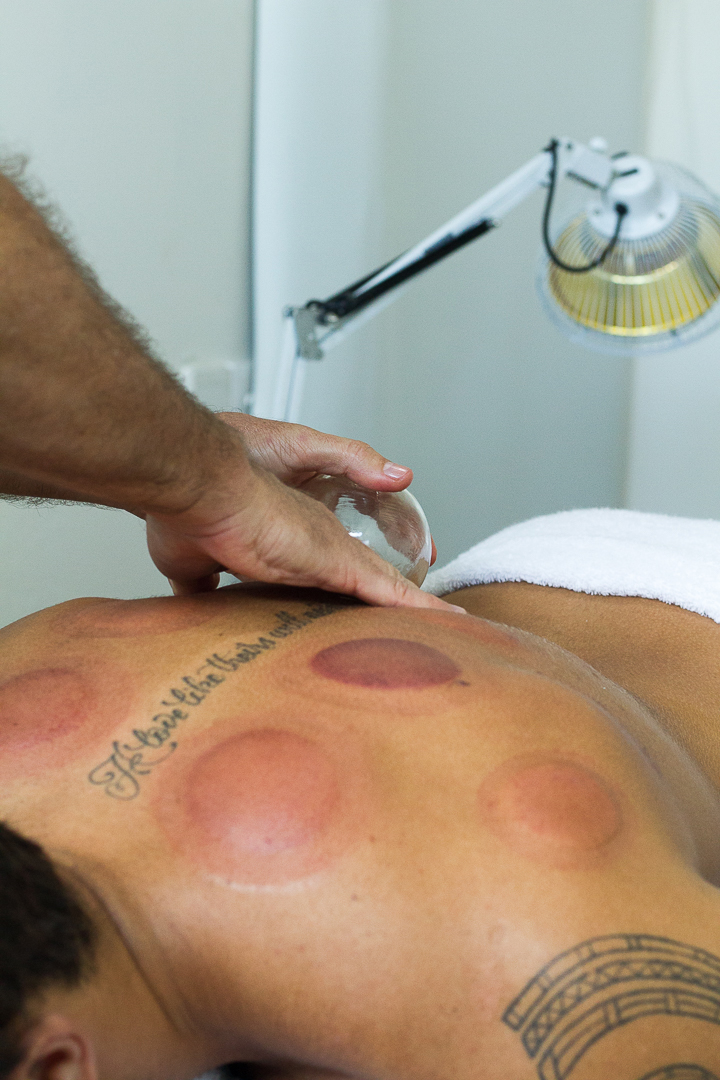 back-pain-acupuncture treatment